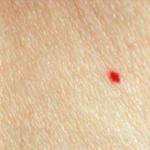 Причины появления красных точек на теле: как вывести красные пятнышки